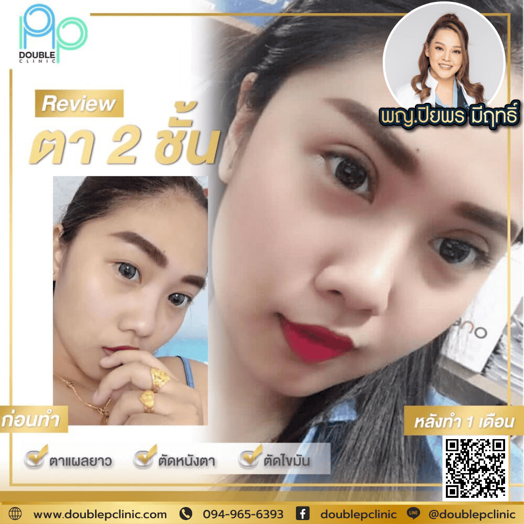 ตาสองชั้น กรีดสั้น คืออะไร ทำอย่างไร