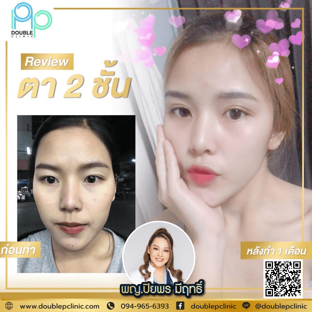 ตัดถุงใต้ตา มีผลเสียไหม
