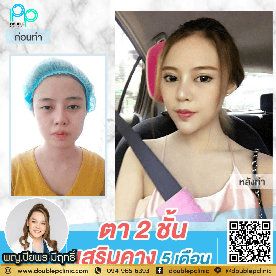 เสริมคางช่วยอะไร