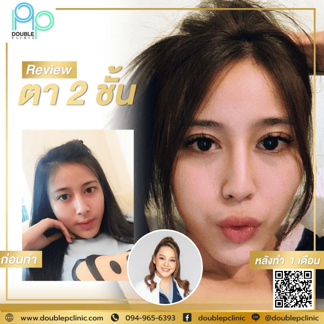 ตัดถุงใต้ตา มีผลเสียไหม