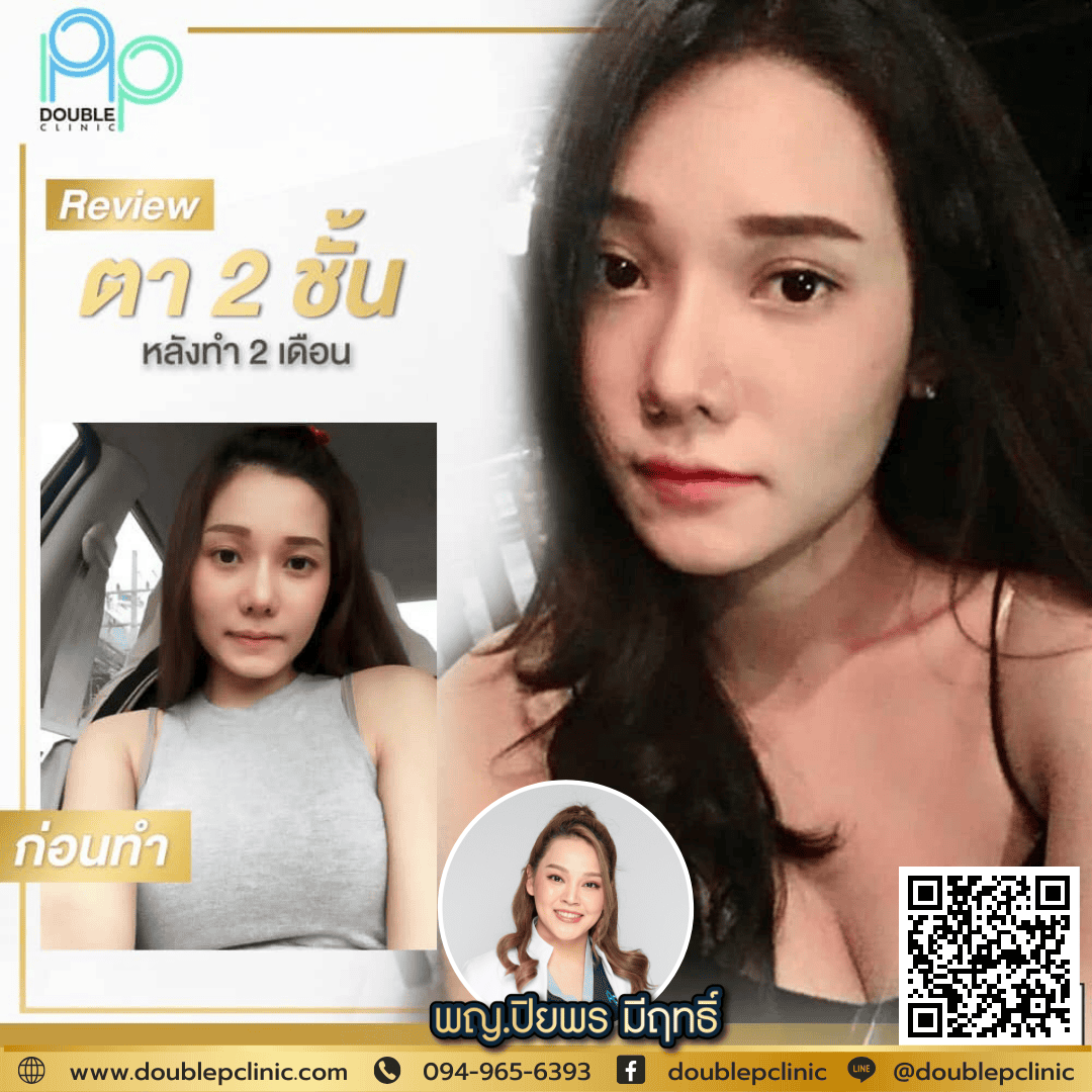 ตัดถุงใต้ตา คือ 