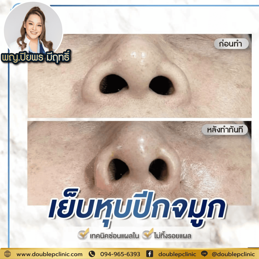 เย็บปีกจมูก กับ ตัดปีกจมูก ต่างกันยังไง