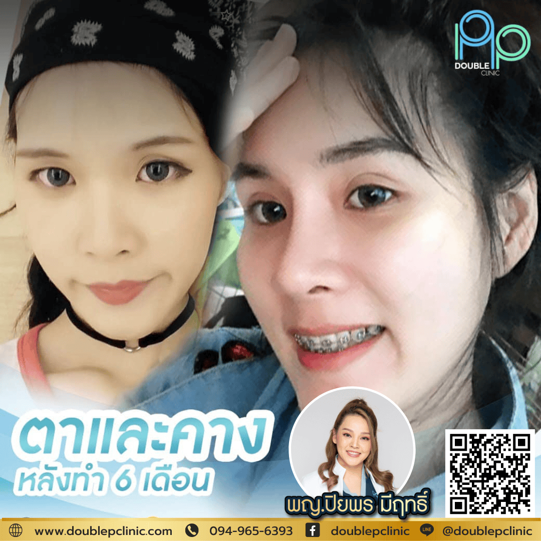  เสริมคางแผลใน แก้อะไร?
