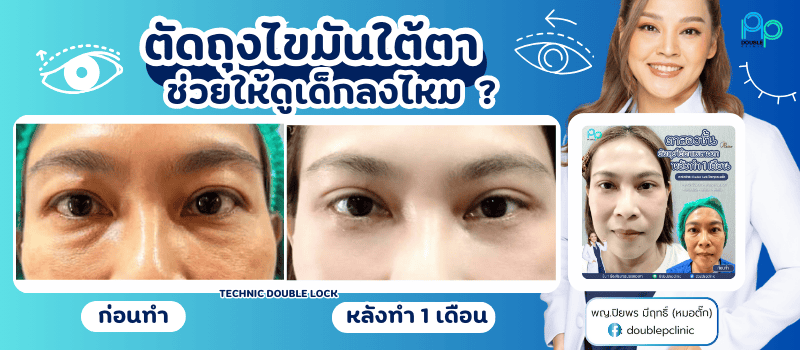 ตัดถุงไขมันใต้ตา ช่วยให้ดูเด็กลงไหม