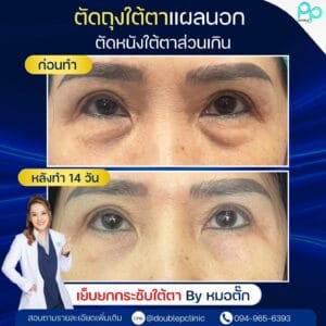 ผ่าตัดถุงใต้ตา ( Eye Bag Surgery ) มีกี่แบบ กี่วิธี