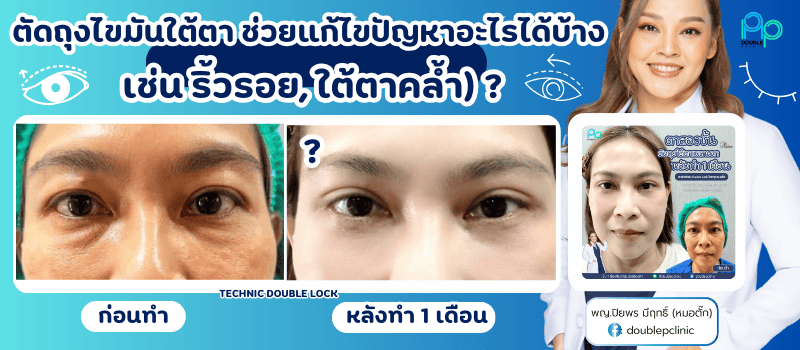 ตัดถุงใต้ตา ช่วยแก้ไขปัญหาอะไรได้บ้าง