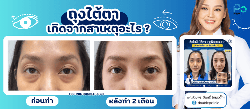 ถุงใต้ตาเกิดจากสาเหตุอะไร