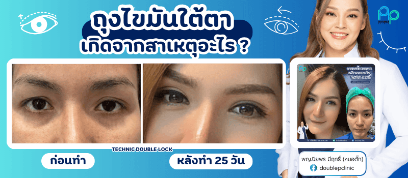 ถุงไขมันใต้ตาเกิดจากสาเหตุอะไร