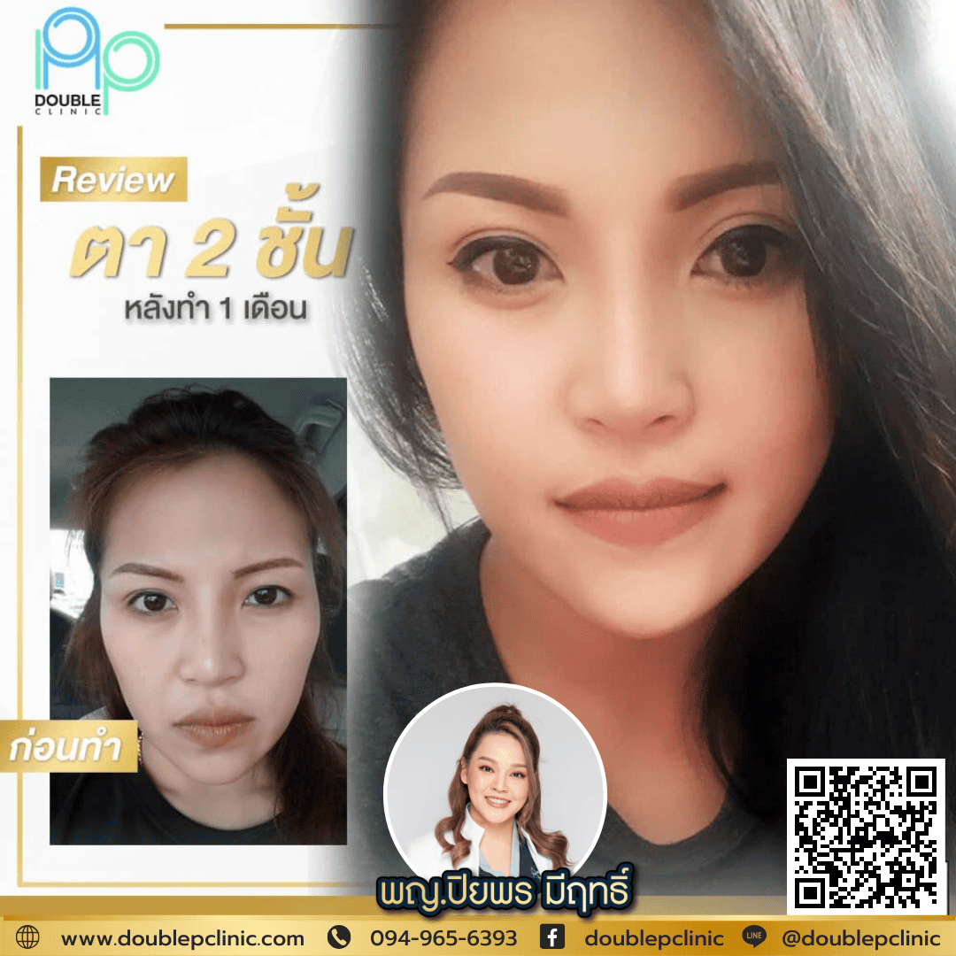 หมอตั๊ก รีวิวทำตาสองชั้น แผลสั้น17
