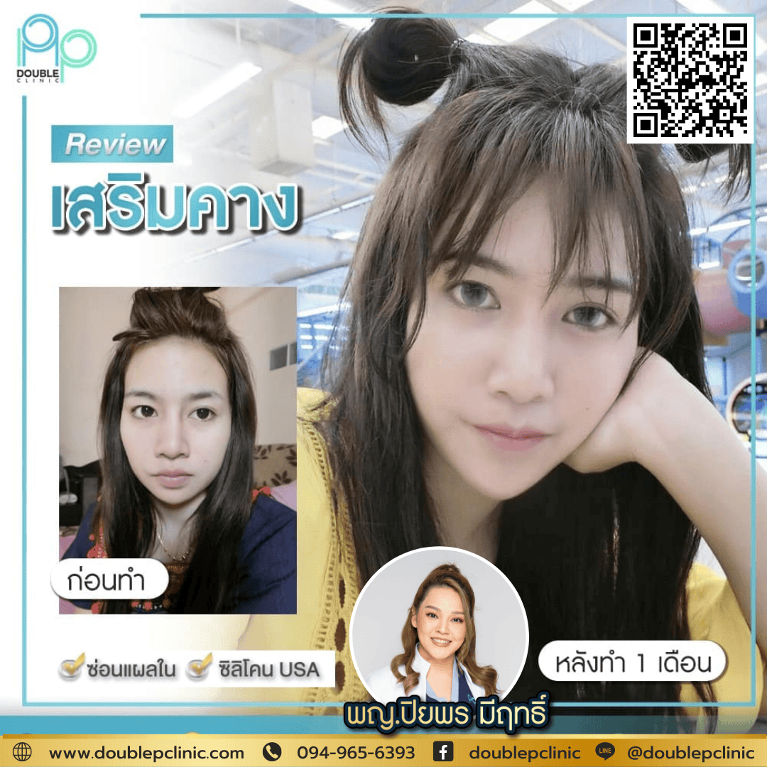เสริมคางแผลใน ต้องพักฟื้นนานไหม?