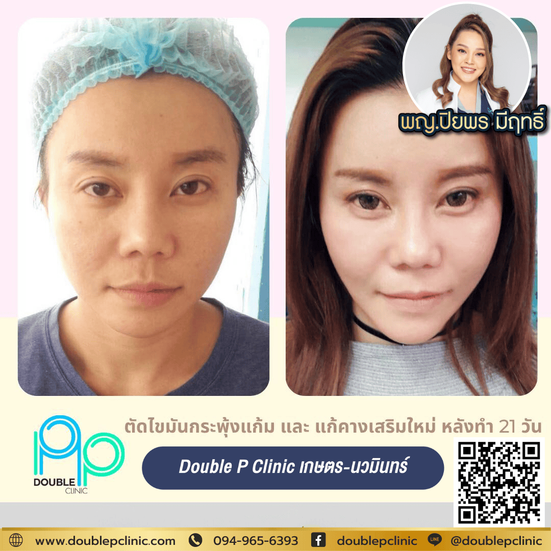 เสริมคางแผลใน กี่วันแต่งหน้าได้?