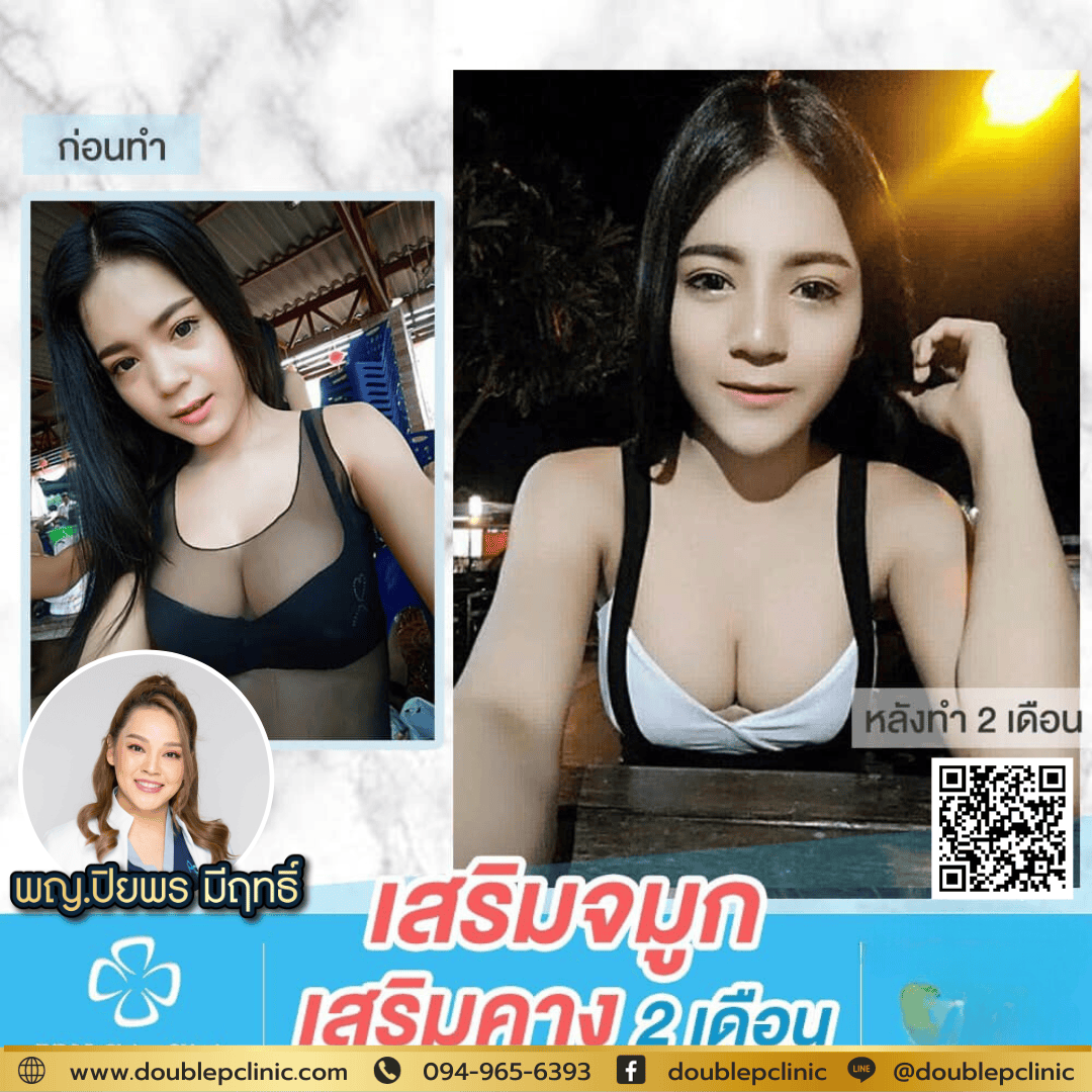 ข้อดี เสริมจมูก