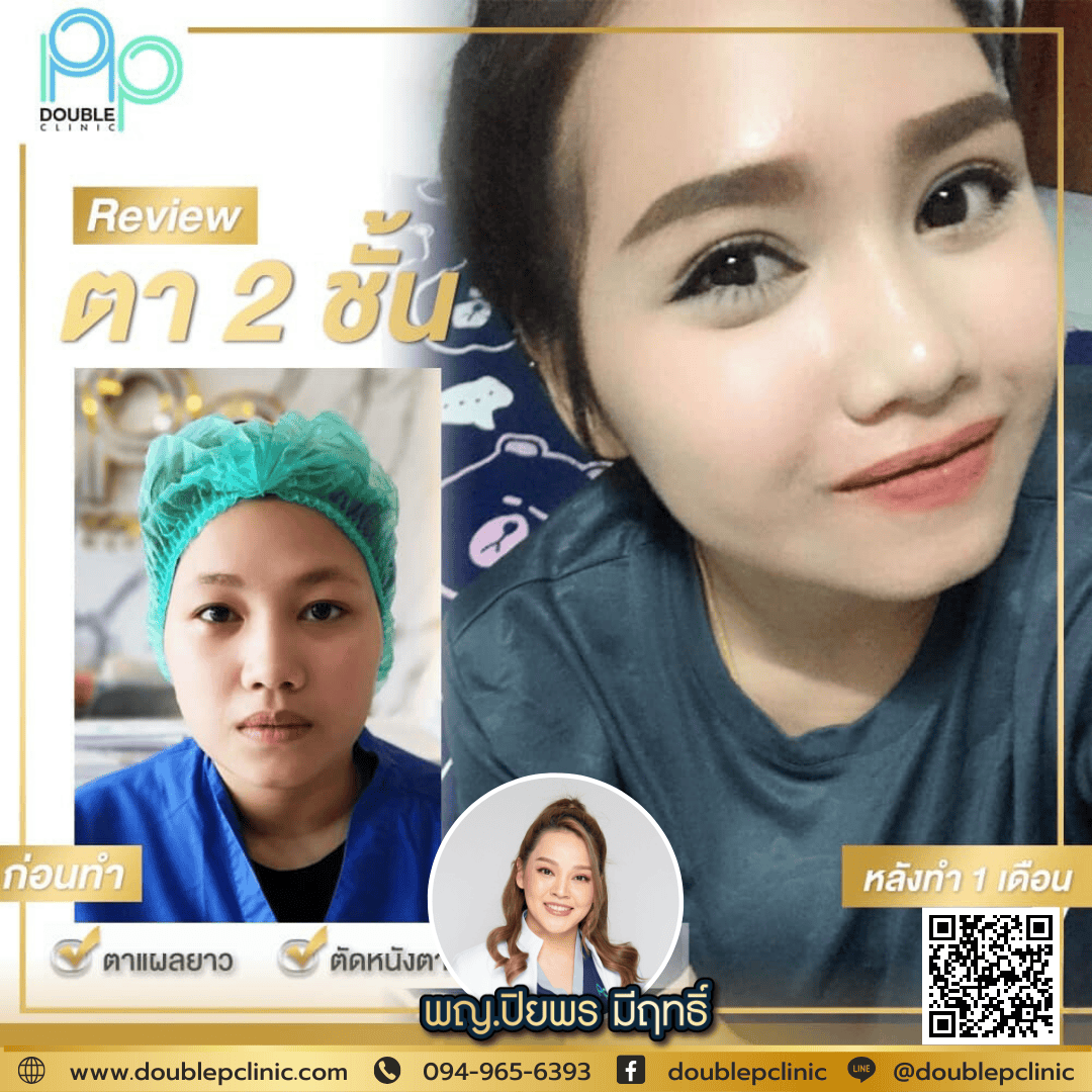 ทำตาสองชั้นเติมไขมันใต้ตา