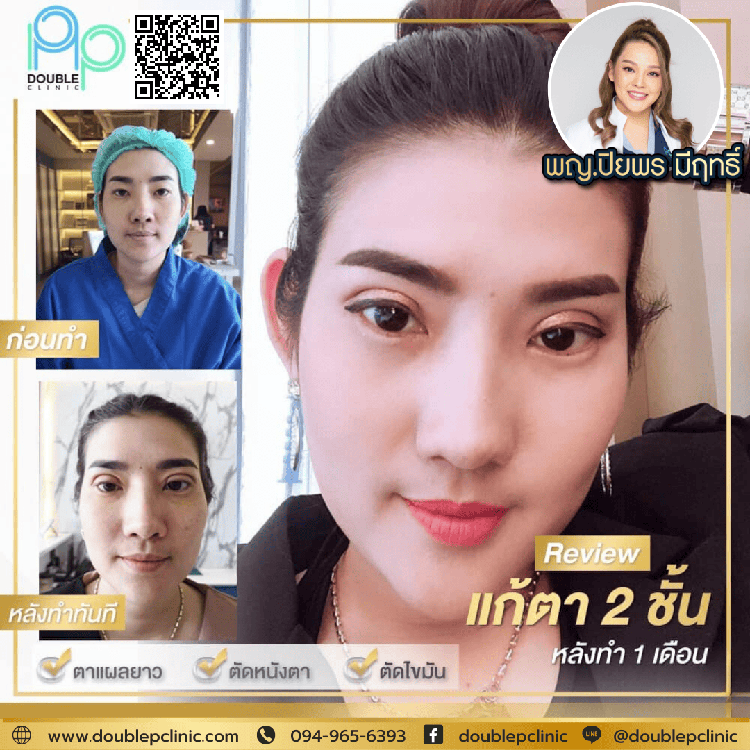 ทำตาสองชั้นเติมไขมันใต้ตา