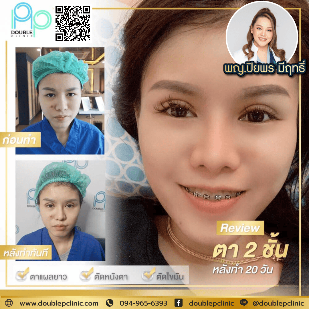ทำตาสองชั้นเติมไขมันใต้ตา