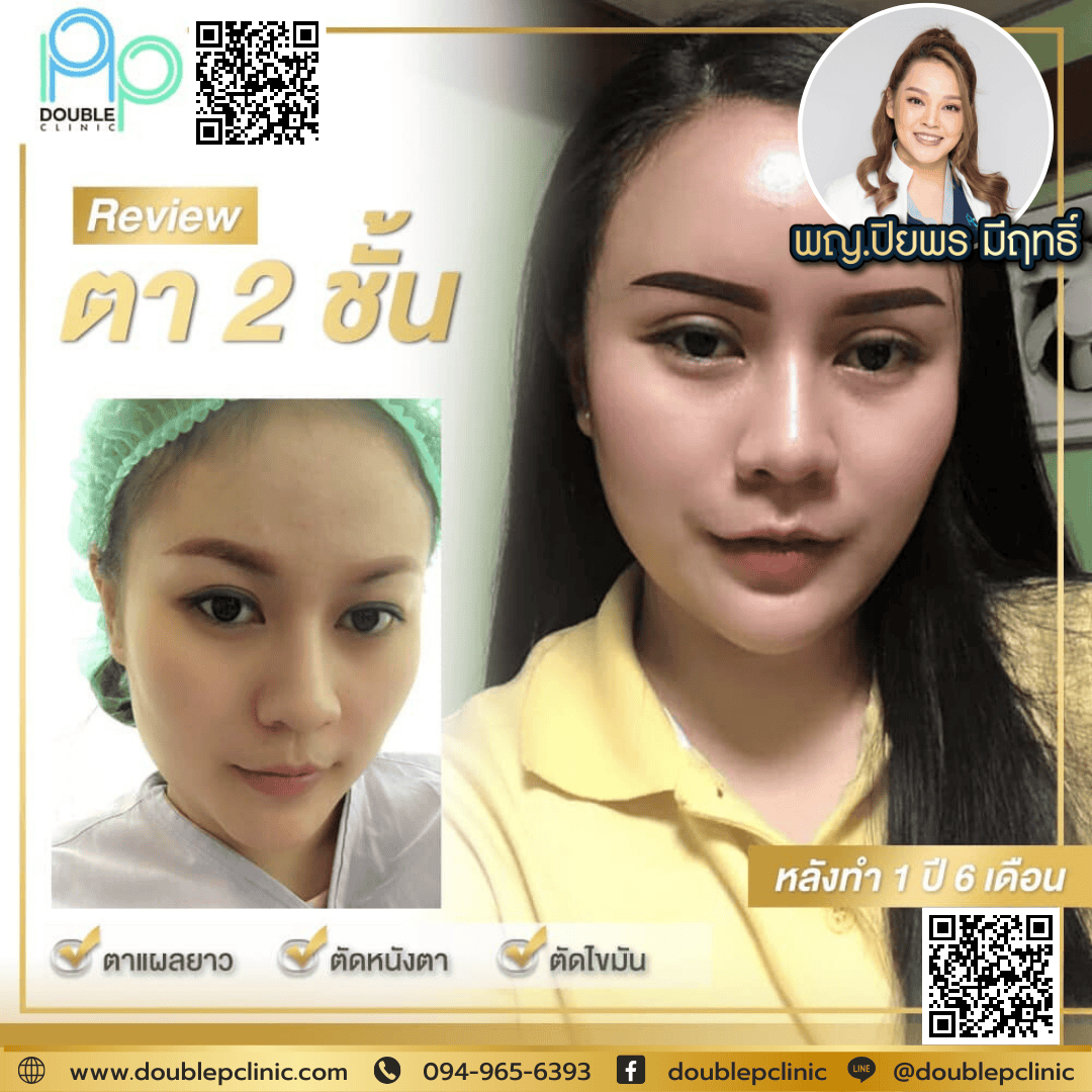 ทำตาสองชั้นเติมไขมันใต้ตา