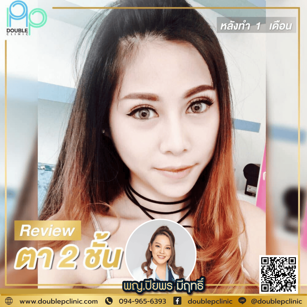 ทำตาสองชั้นเติมไขมันใต้ตา