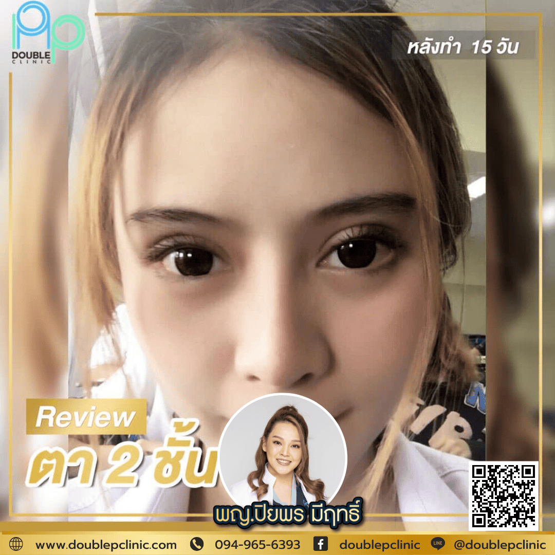 ทำตาสองชั้นเติมไขมันใต้ตา