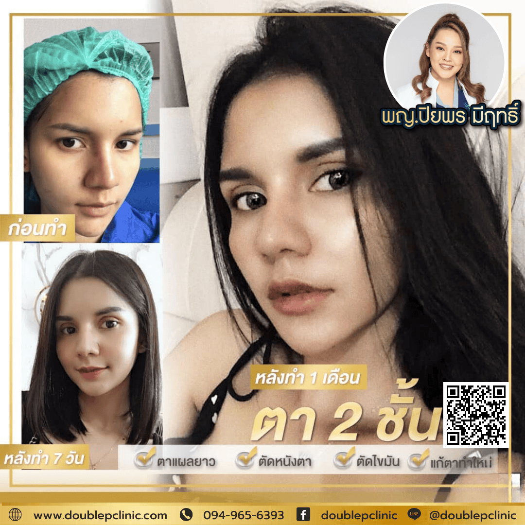 ทำตาสองชั้น Double P Clinic คุณหมอตั๊ก ราคาเท่าไร