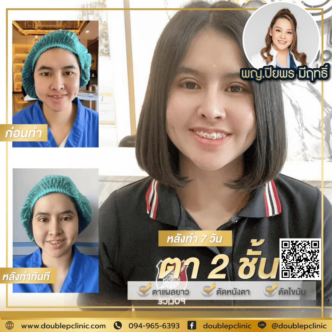 ทำตาสองชั้นเติมไขมันใต้ตา
