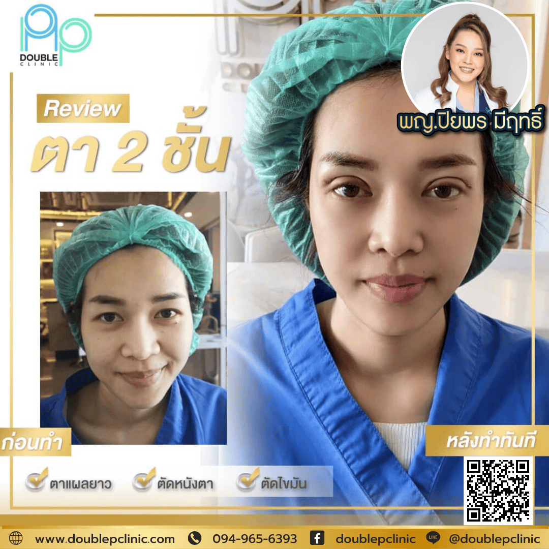 ทำตาสองชั้นเติมไขมันใต้ตา