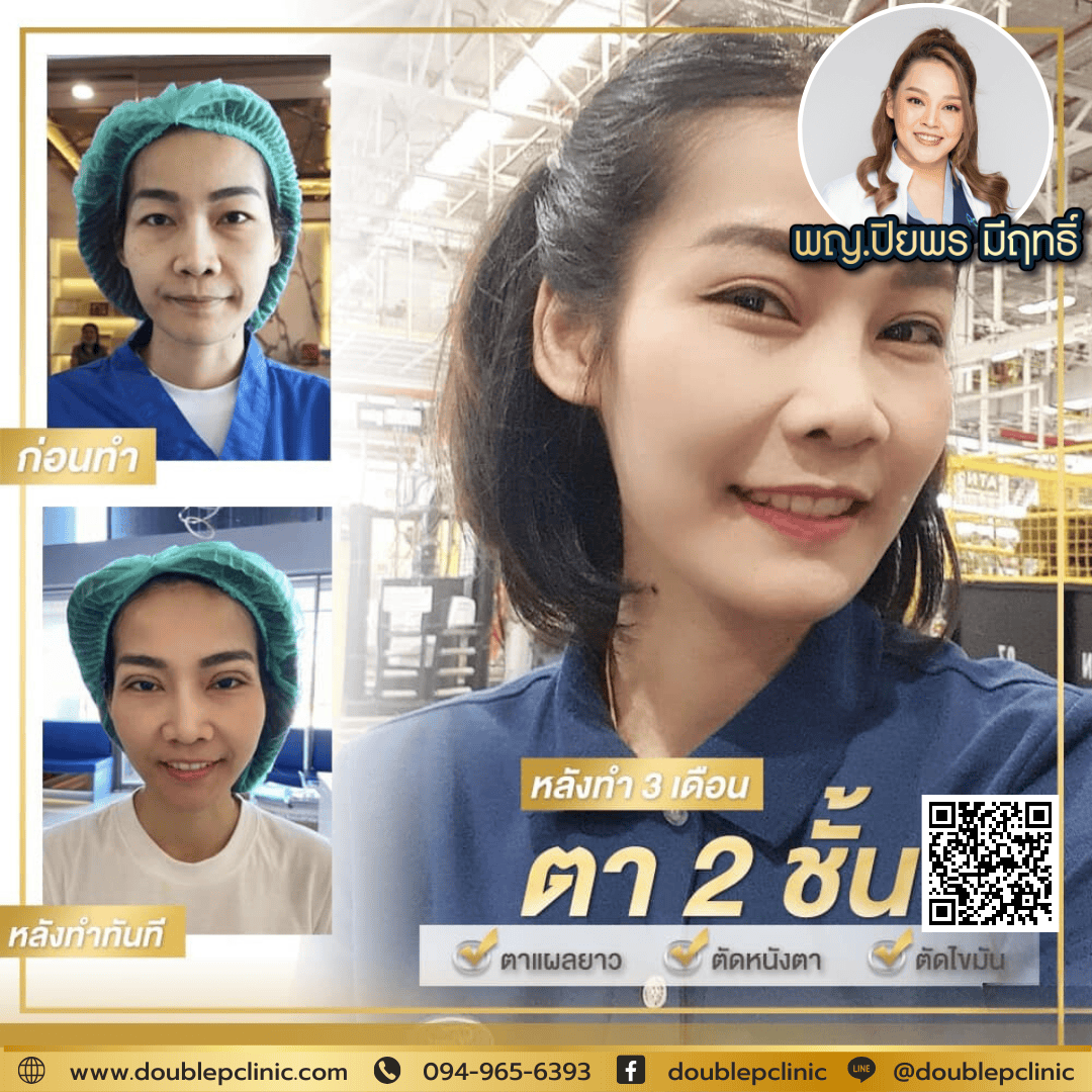 ทำตาสองชั้นเติมไขมันใต้ตา