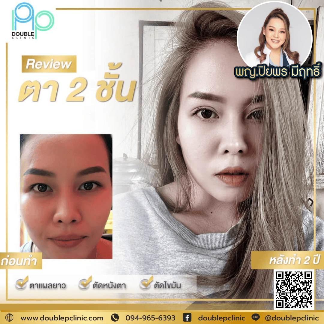 ทำตาสองชั้นเติมไขมันใต้ตา