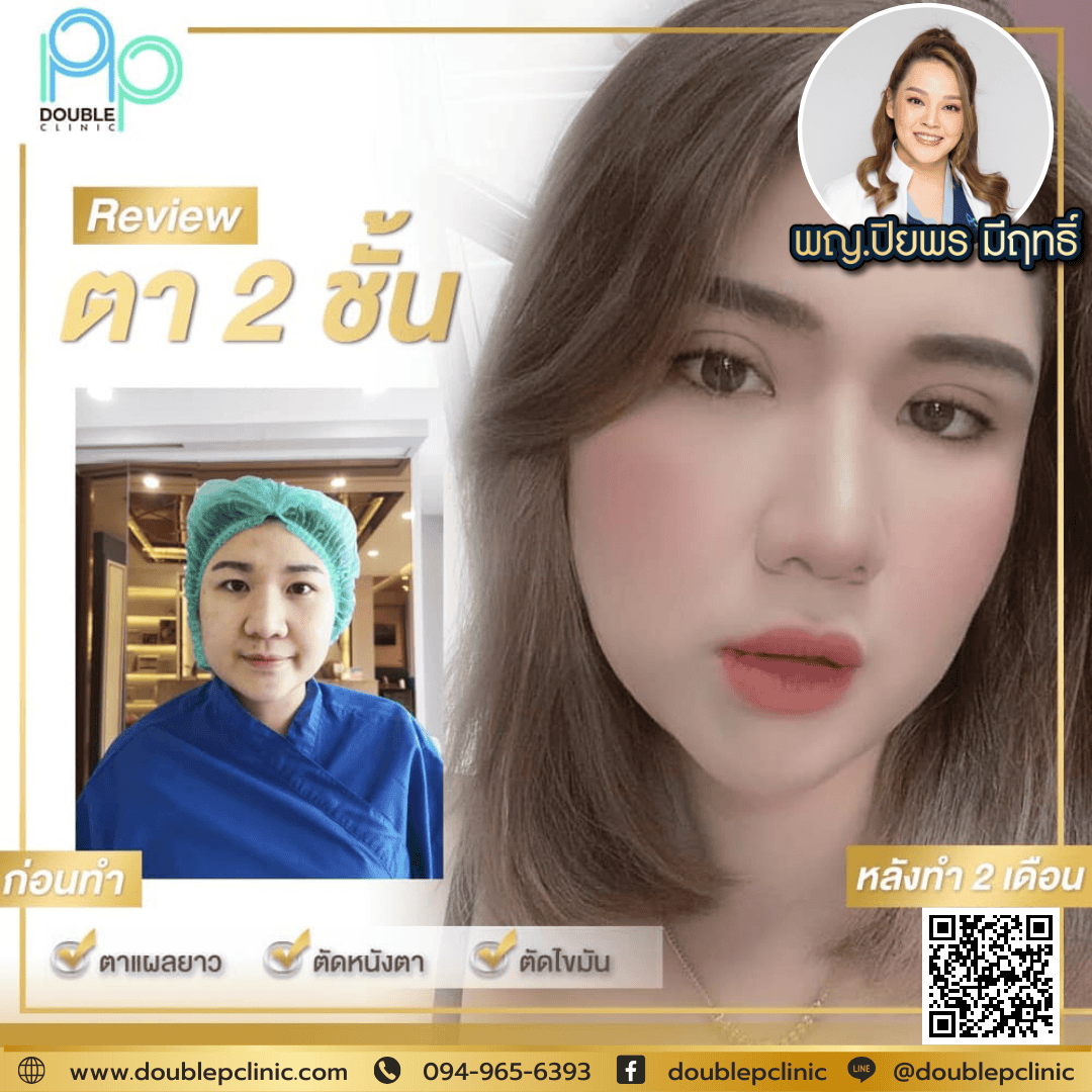 ทำตาสองชั้นเติมไขมันใต้ตา