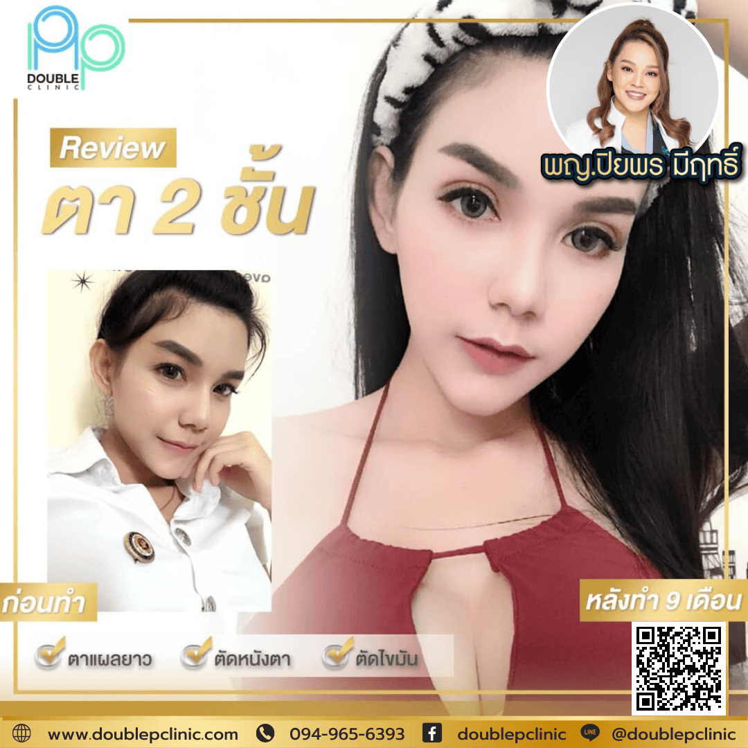 ทำตาสองชั้นกับ Double P Clinic ราคาเท่าไร