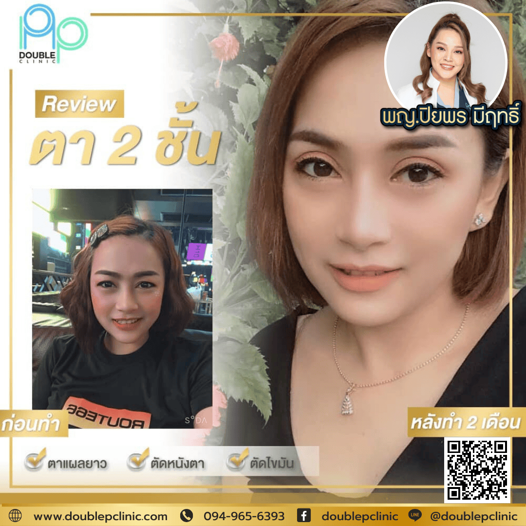 ทำตาสองชั้นกับ Double P Clinic ราคาเท่าไร
