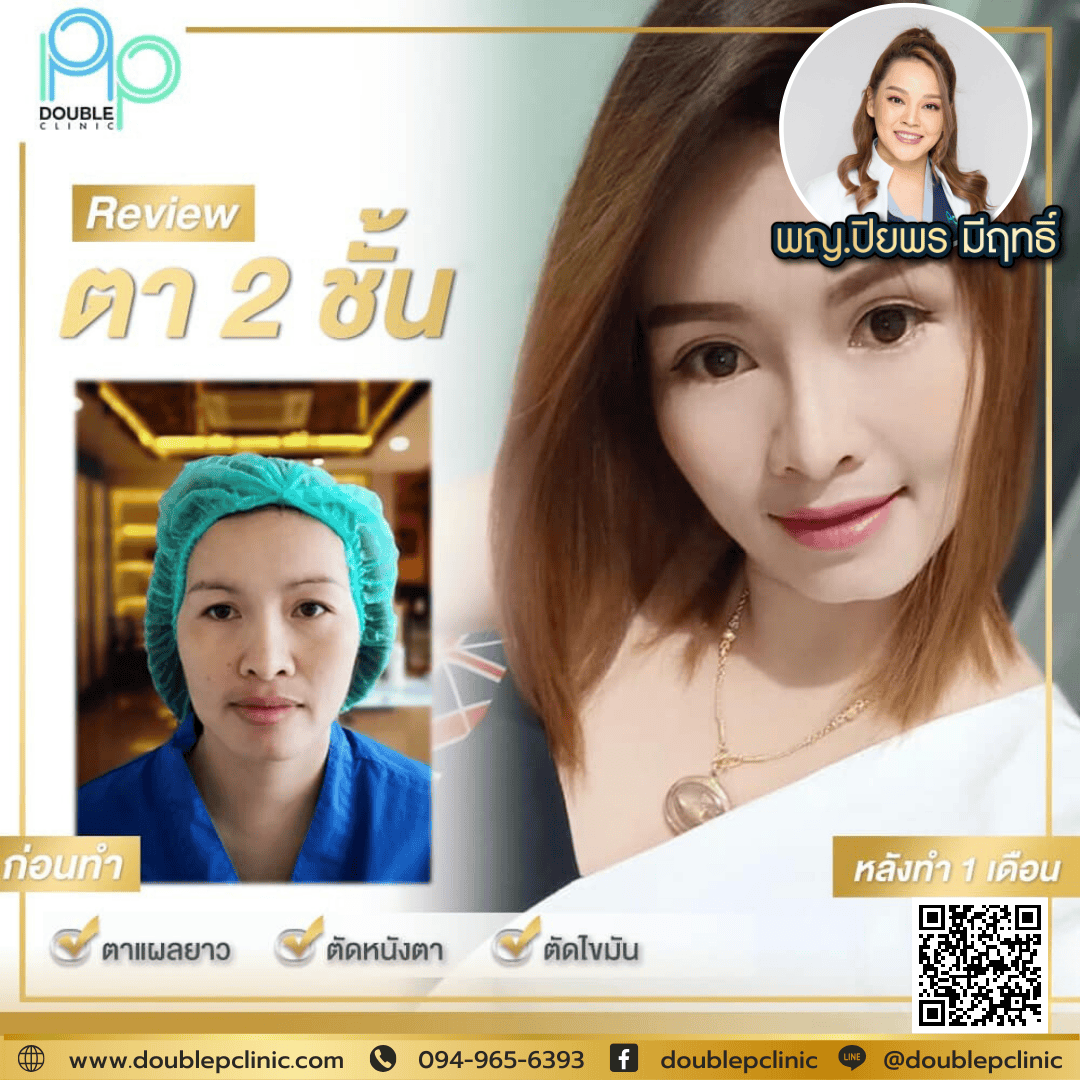 ทำตาสองชั้นเติมไขมันใต้ตา