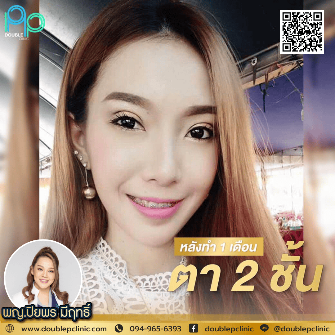 ทำตาสองชั้น แผลสั้น
