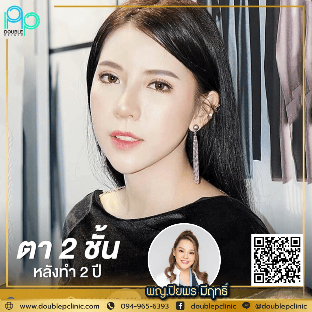 ทำตาสองชั้น แผลสั้น