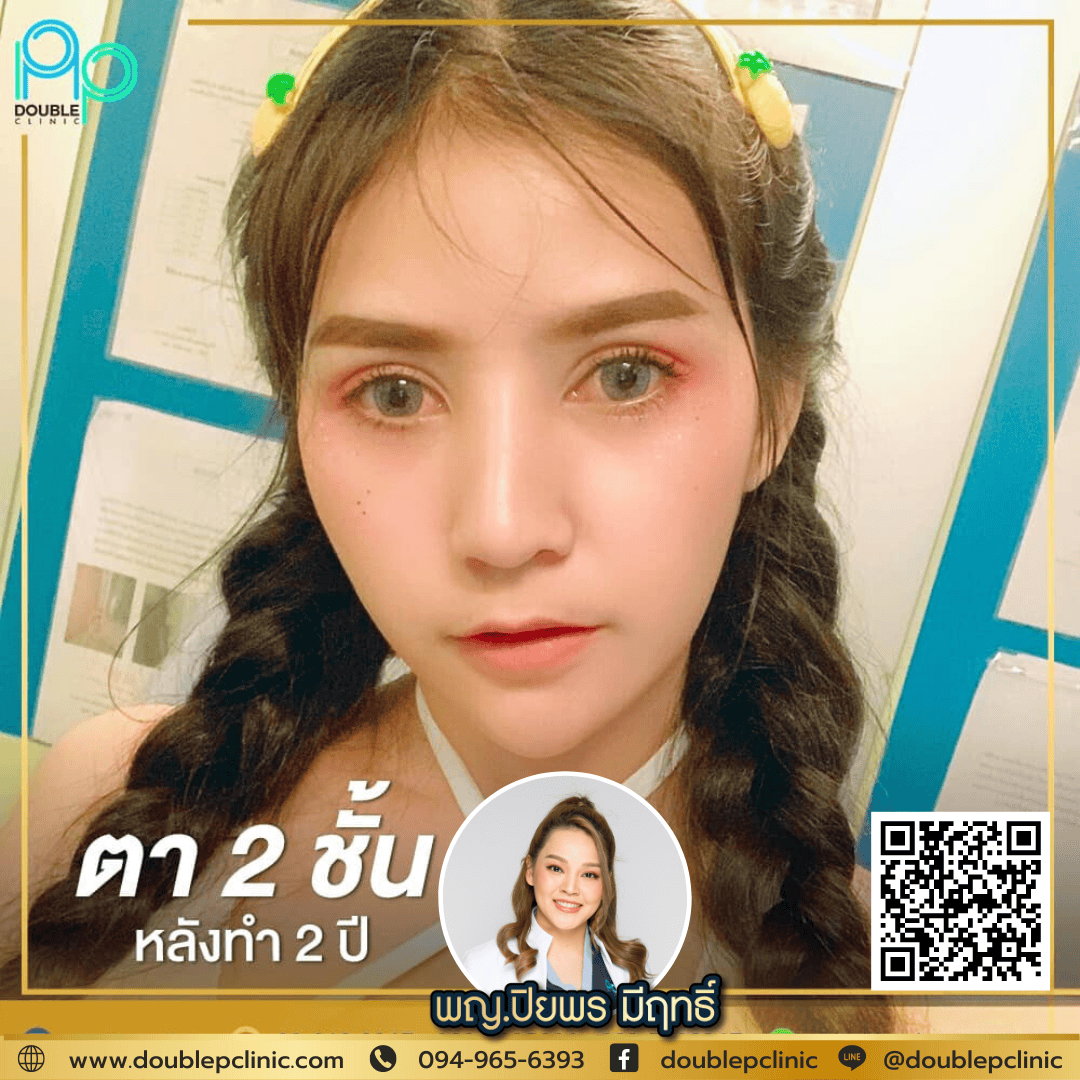 ทำตาสองชั้น แผลสั้น