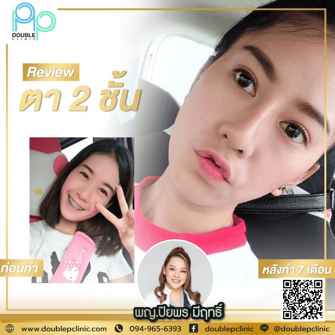 ทำตาสองชั้น แผลสั้น