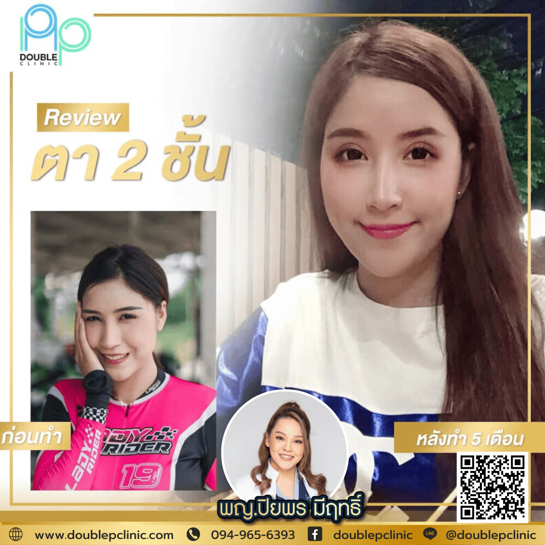 ทำตาสองชั้น แผลสั้น