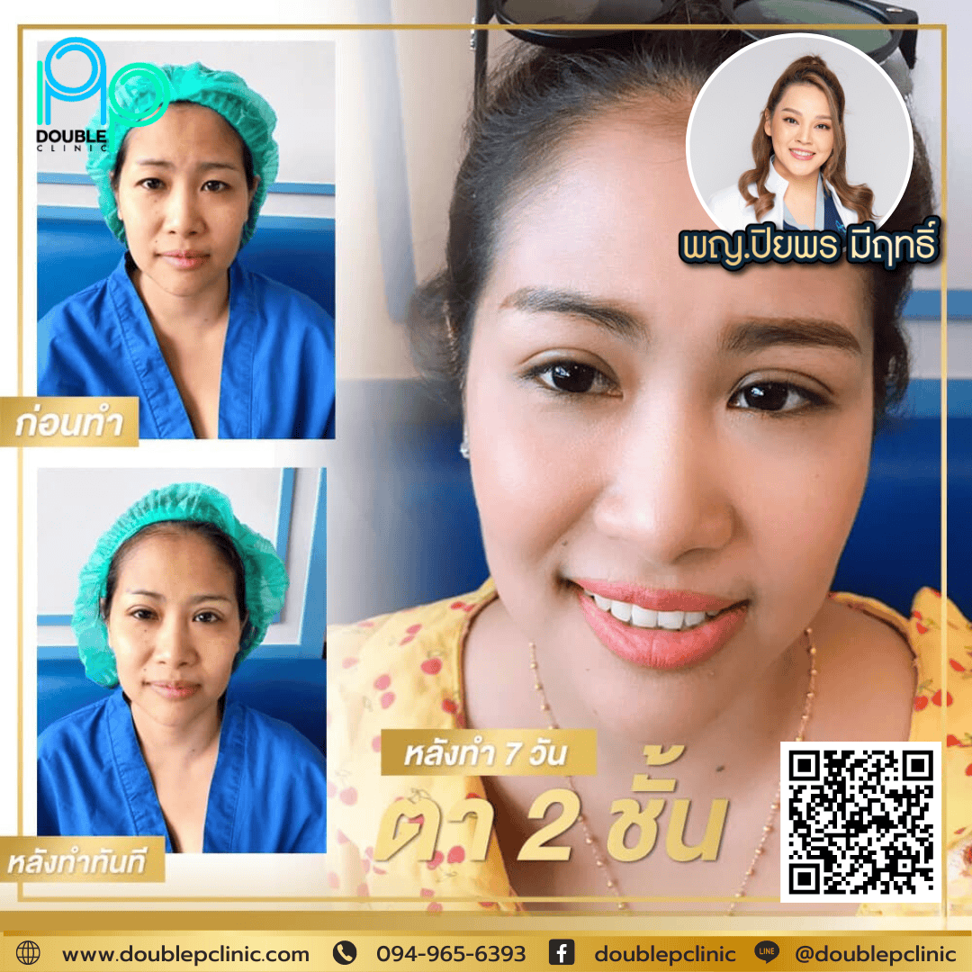 ทำตาสองชั้น แผลสั้น