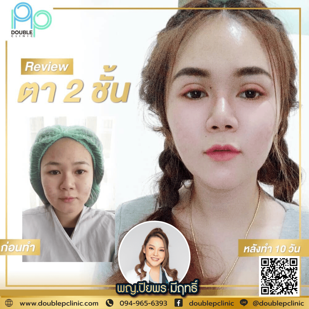 ทำตาสองชั้น แผลสั้น
