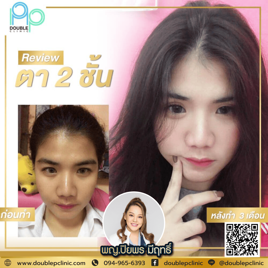 ทำตาสองชั้นเติมไขมันใต้ตา