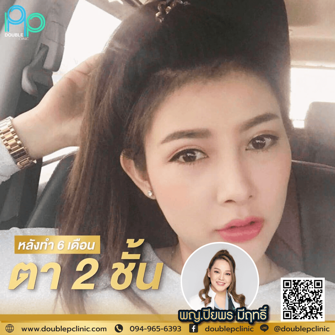ทำตาสองชั้น แผลสั้น