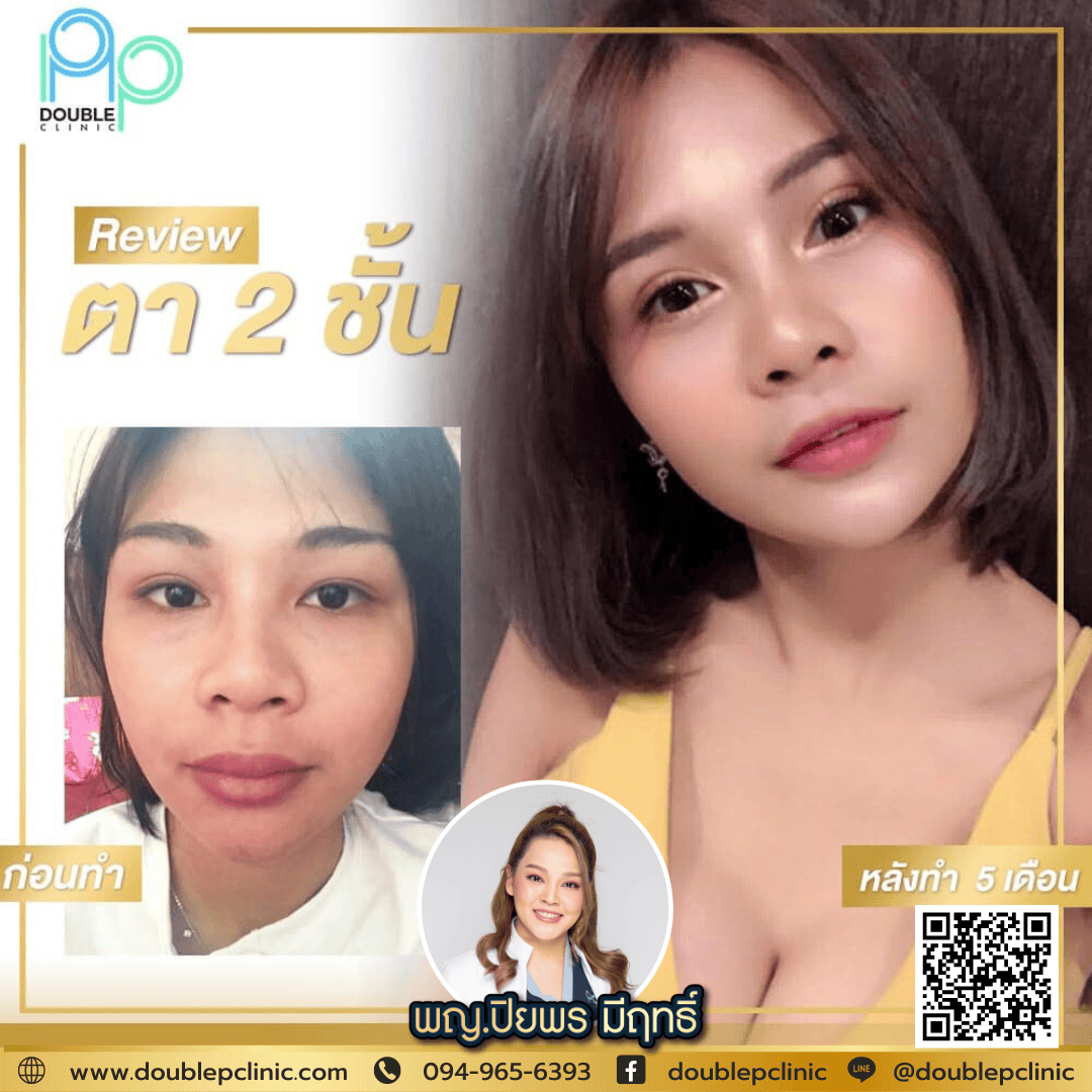 ทำตาสองชั้น แผลสั้น