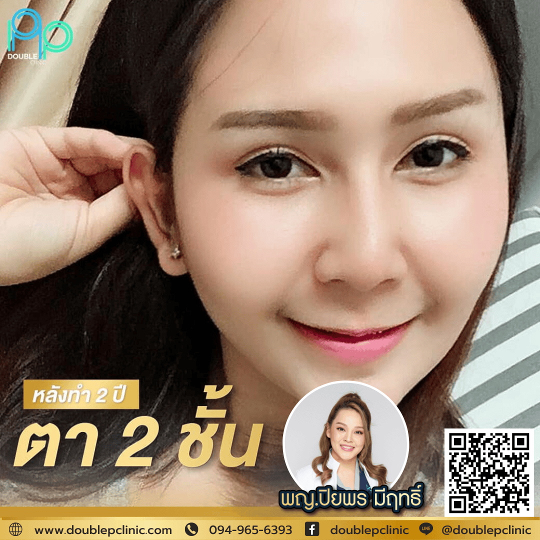 ทำตาสองชั้นเติมไขมันใต้ตา