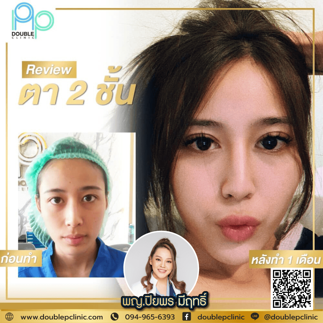 ทำตาสองชั้น แผลสั้น