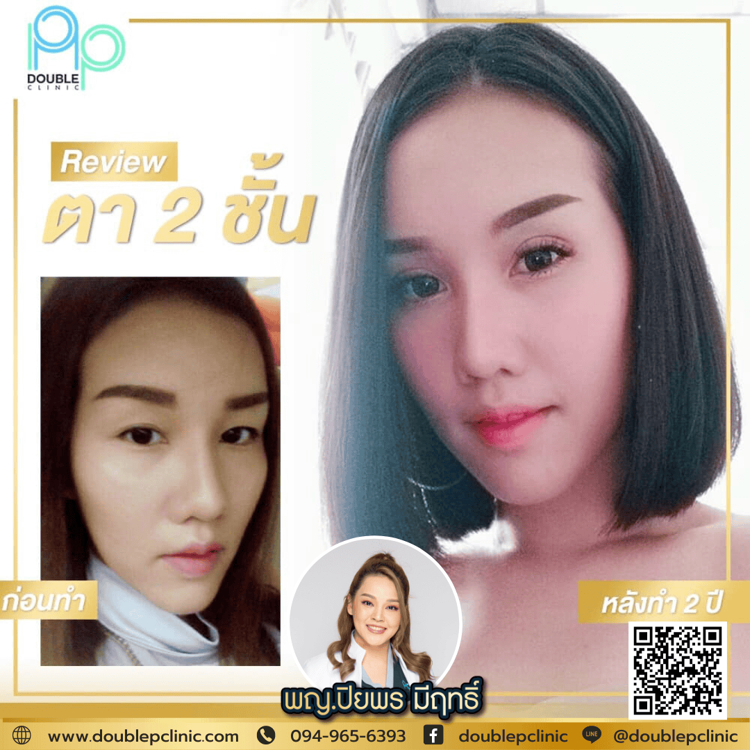 ทำตาสองชั้น แผลสั้น