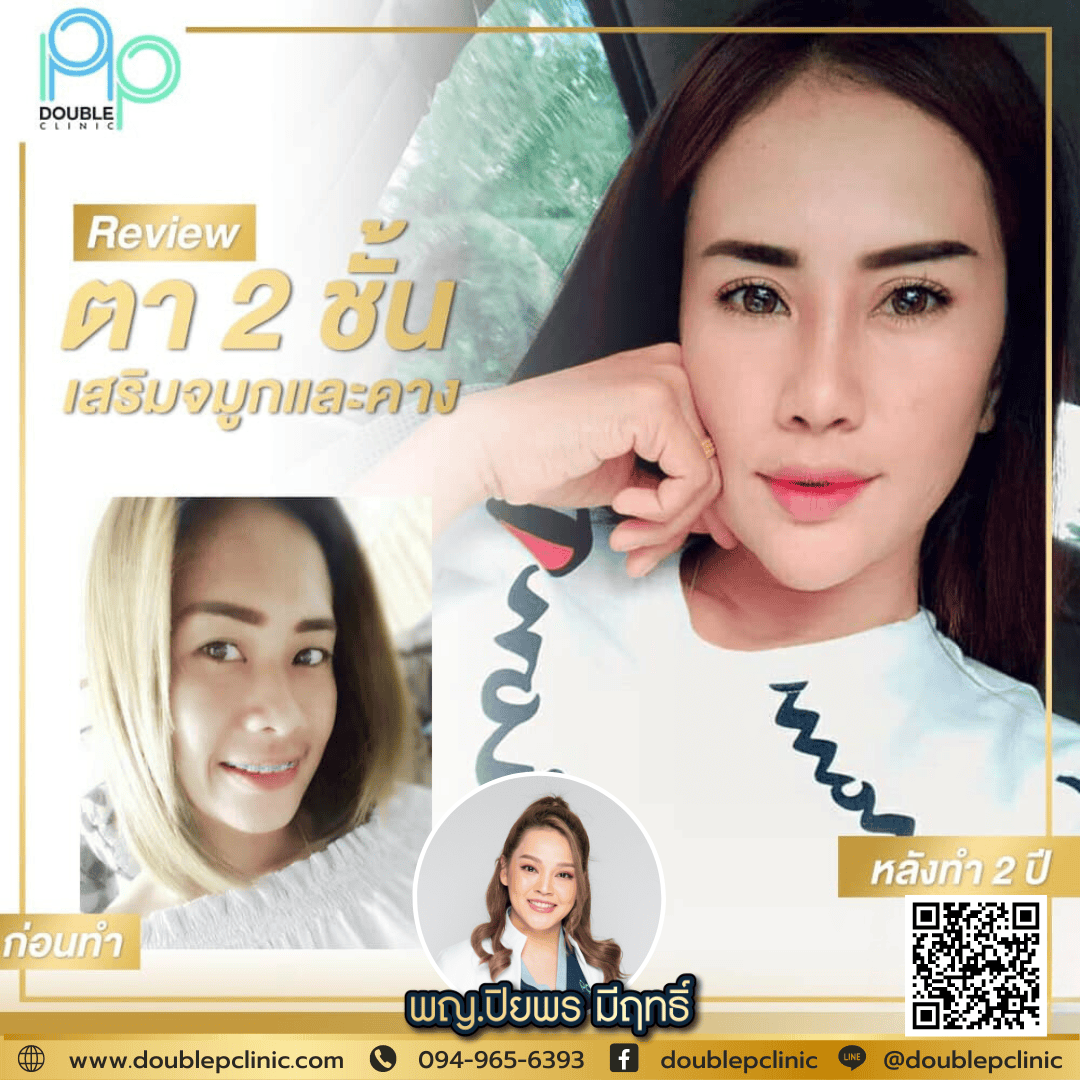 ทำตาสองชั้น แผลสั้น