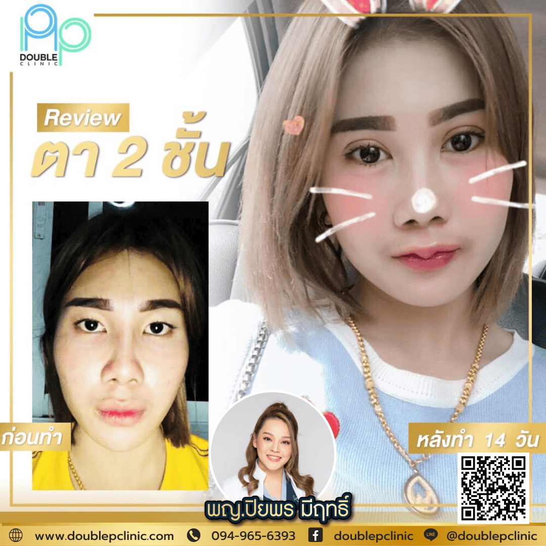 ทำตาสองชั้น แผลสั้น