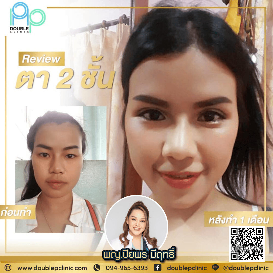 ทำตาสองชั้น แผลสั้น