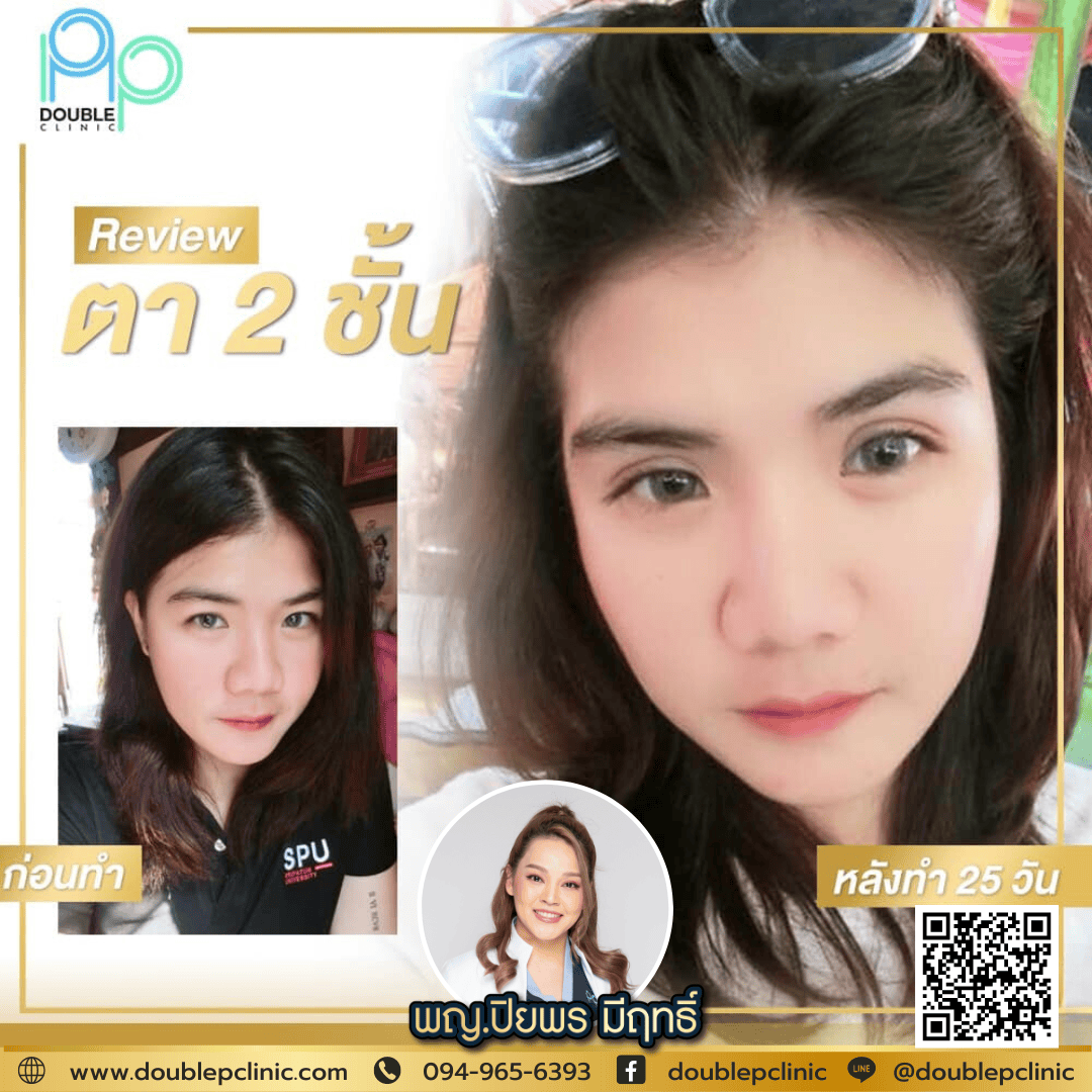 ทำตาสองชั้นเติมไขมันใต้ตา