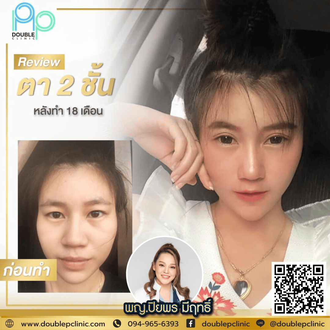 ทำตาสองชั้นเติมไขมันใต้ตา