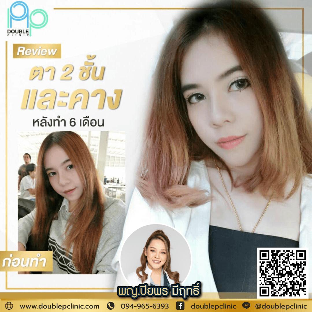 ทำตาสองชั้นเติมไขมันใต้ตา